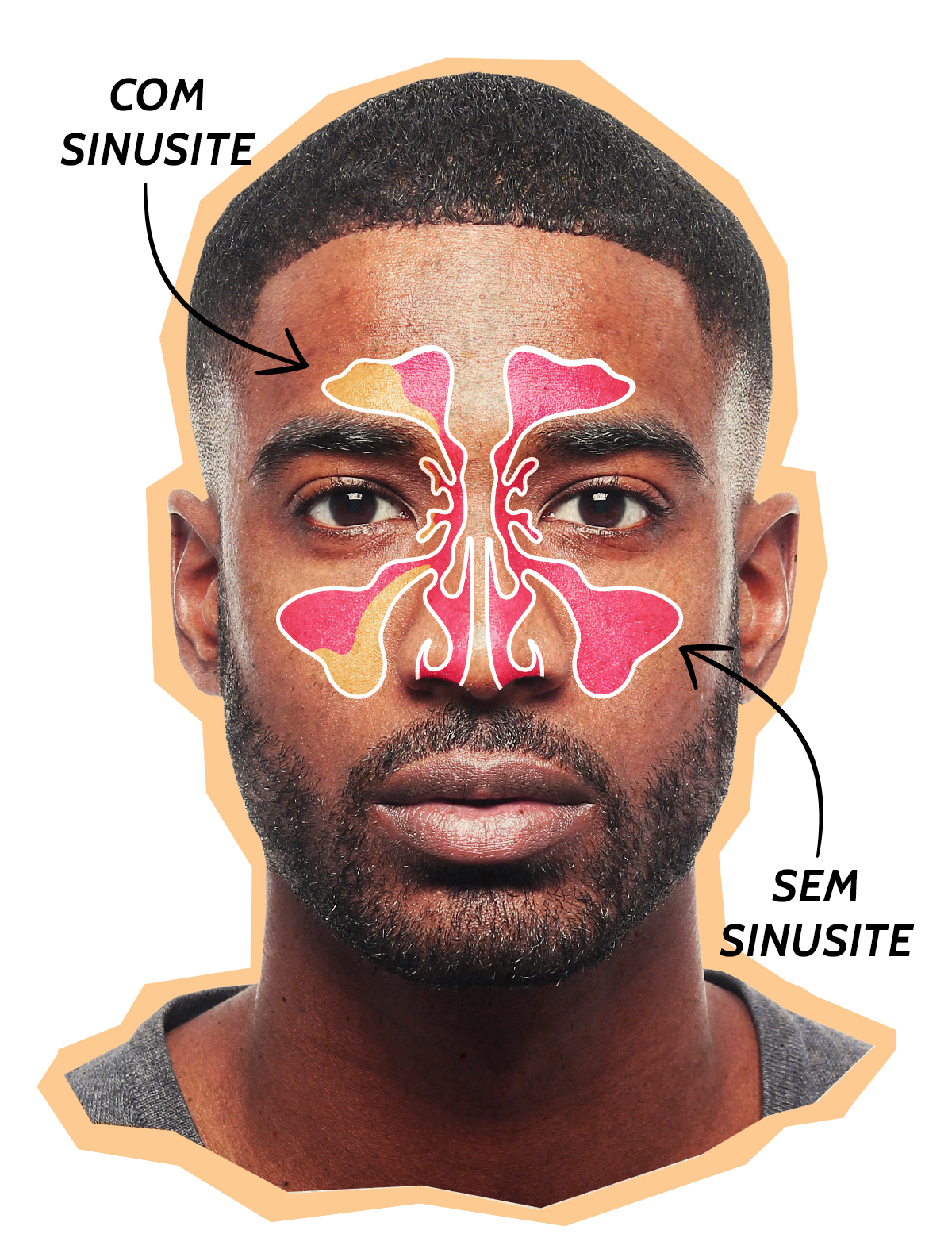 sinusite_sintomas
